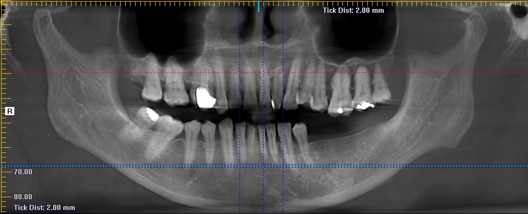 PARANASAL SINUS